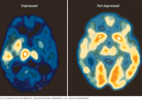 Ct scan of a human brain showing before and after views with new neural activity