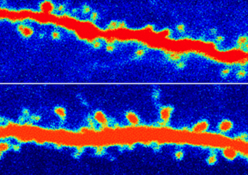 Close up view of new neural growth in the brain after ketamine infusion